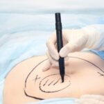 Scars after Tummy Tuck