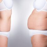 What is lipoabdominoplasty
