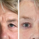 Brow Lift