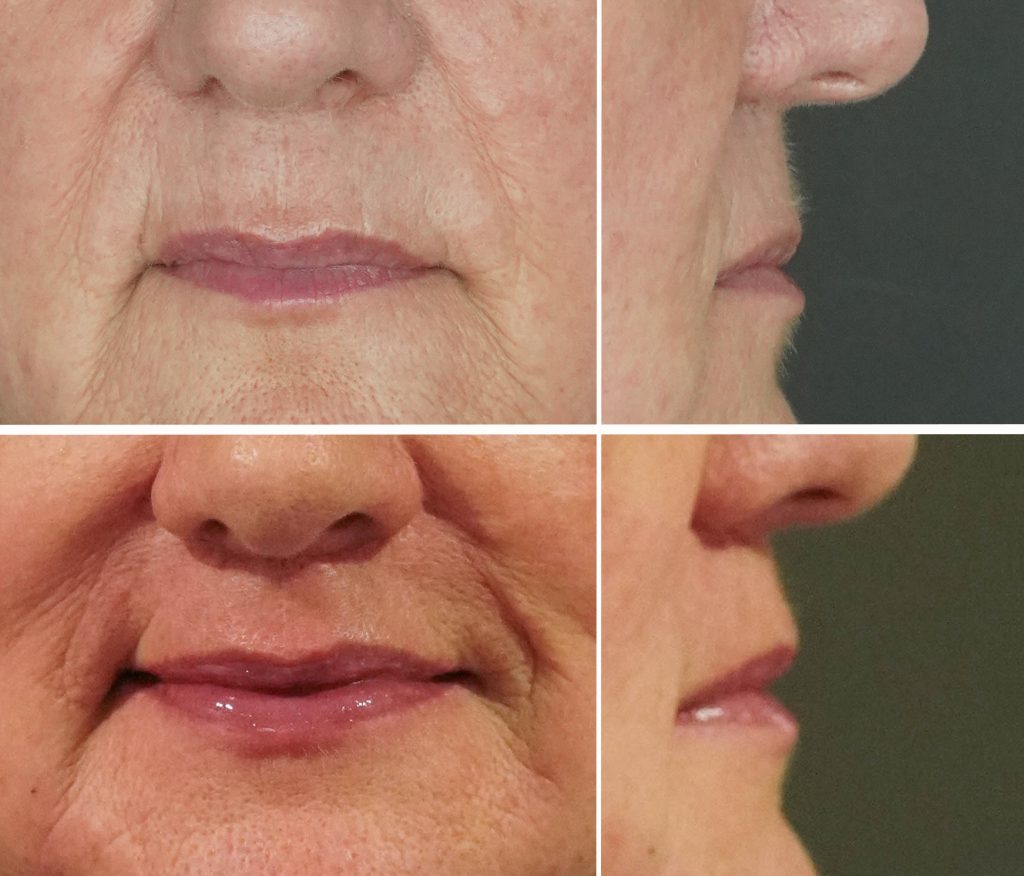 KF lip lift image